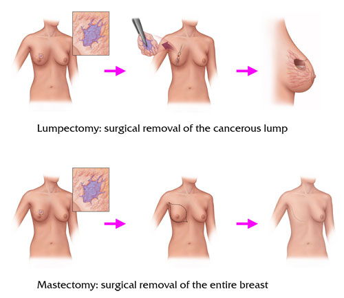 Breast cancer treatment