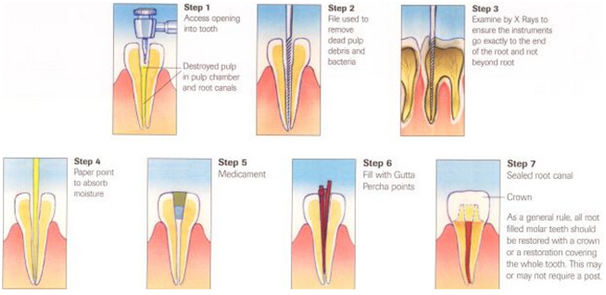 Root Canal Cost