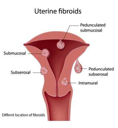 Fibroids Treatment