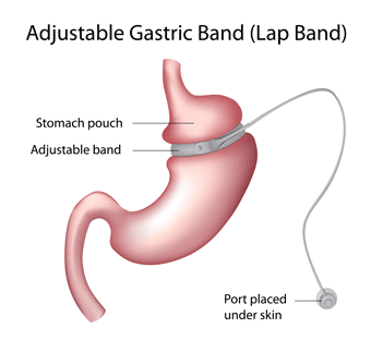 Gastric Band Surgery