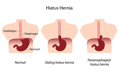 Hernia treatment