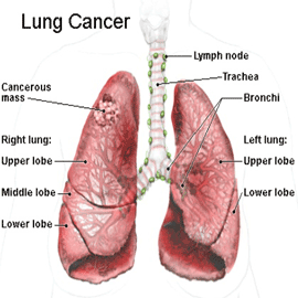 Lungs cancer treatment in India