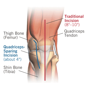 Minimally Invasive Knee Replacement