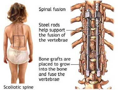 Scoliosis surgery