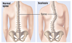 Scoliosis surgery