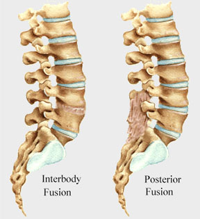 Spinal fusion surgery