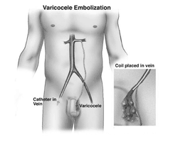 Best Varicocele Treatment